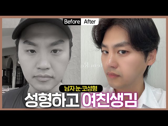 [성형전후] 성형하고 여자친구 생겼어요😊 #성형전후 #남자코성형 #남자눈성형