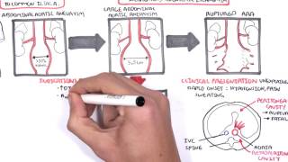 Abdominal Aortic Aneurysm - Summary Resimi