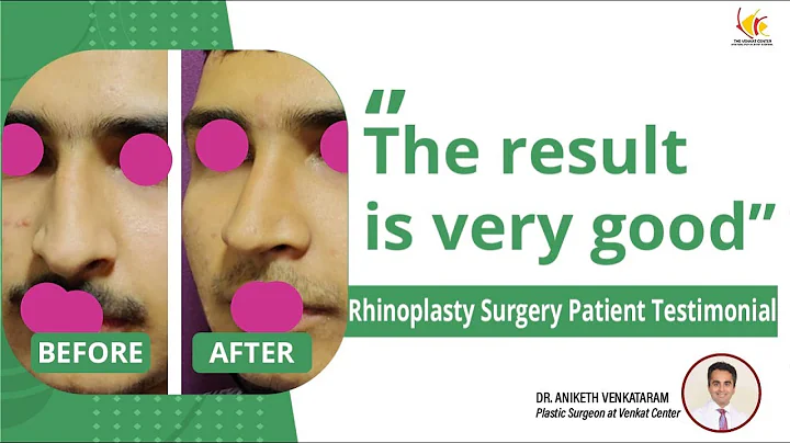 Patient Experience Series: Rhinoplasty Surgery