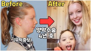 [헝가리부부] 무턱 증상으로 양악수술후 4년만에 치아교정기를 빼고 건강한 미소를 되찾은 헝가리아내😄❤️ / #양악수술 #국제가족 #김패밀리