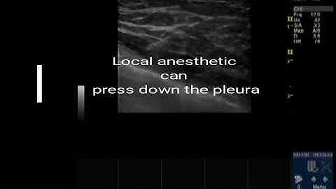 Transversus thoracic muscle plane block-02