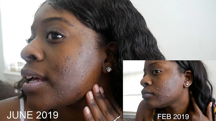 4 Month Skin Update | How I Cleared My Acne + Products I'm Using