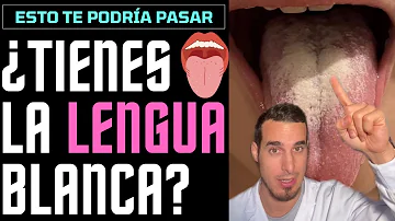 ¿Puede la falta de higiene causar lengua blanca?