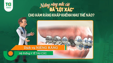 Niềng Răng Mắc Cài đã lột xác cho hàm răng khấp khểnh như thế nào?