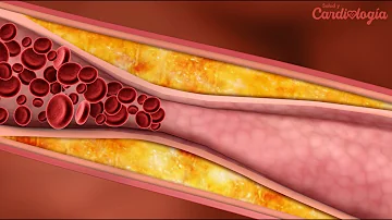 ¿Cuál es la causa principal de la obstrucción de las arterias?