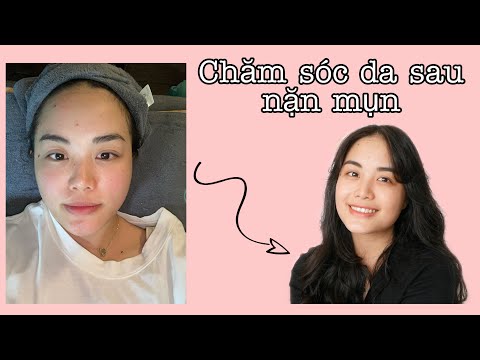Cuối cùng mình cũng đã có mụn để đi nặn mụn rồi làm video chăm sóc da mụn =))) | LAN ANH ♡