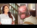 Man Has Water Balloon Ticking Time Bomb On The Back Of Head | Dr. Pimple Popper