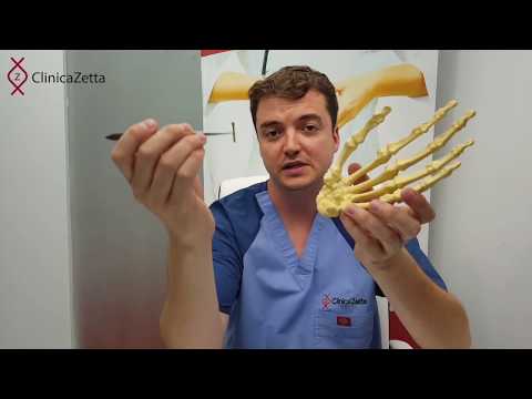 Fractura Osului Scafoid - Simptome si Tratament - Doctor Daniel Vilcioiu