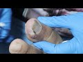 Ep_3239 Ingrown toenail removal 👣 เล็บแทง..จนนิ้วบวมอักเสบ 😉 (This clip is from Thailand)