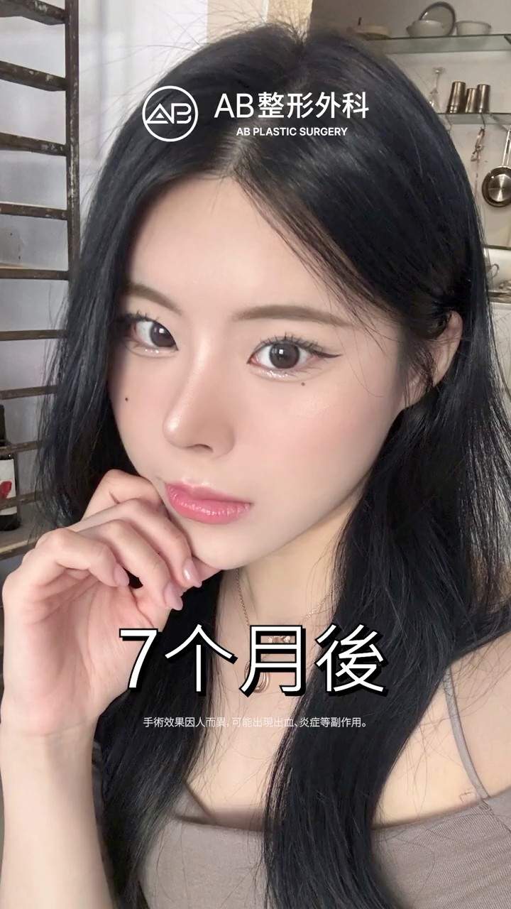 輪廓三件套＋鼻整形，側臉也變得超好看✨ #Shorts