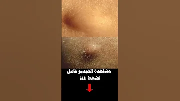 هل الكيس الدهني خطير 