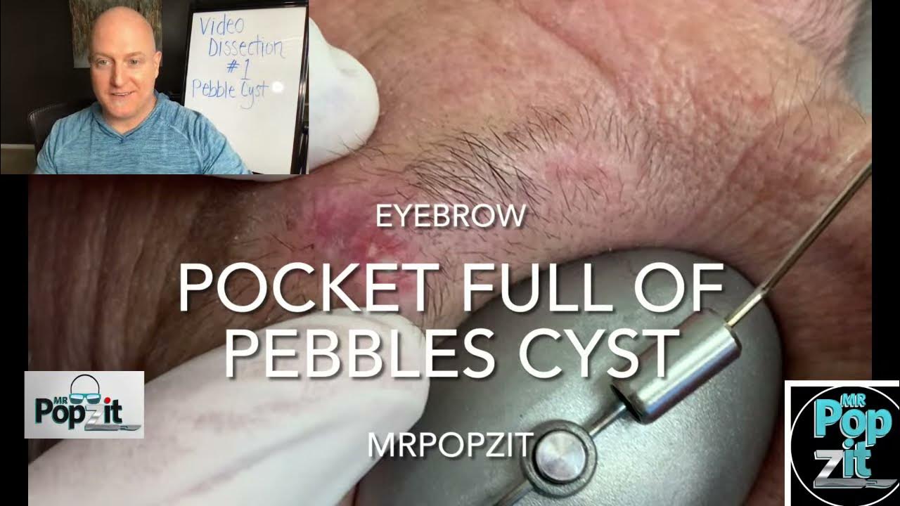 Pocket Full of Pebbles Cyst YouTube