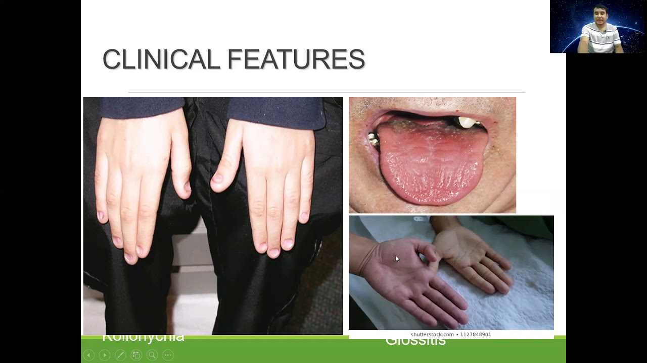 Iron deficiency anemiaDr Bhupendra Shahmedicine classroom YouTube