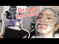 I GOT BRACES AGAIN!!! 😩 (Philippines) | Jewel Mesina