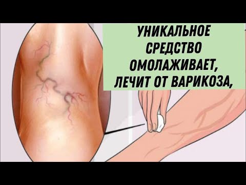 Эффективное ЛЕЧЕНИЕ ВАРИКОЗА в домашних условиях / Как вылечить варикоз народными средствами