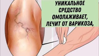 Эффективное ЛЕЧЕНИЕ ВАРИКОЗА в домашних условиях / Как вылечить варикоз народными средствами