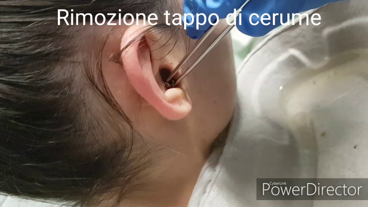 Come rimuovere il tappo di cerume e liberare le orecchie - YouTube