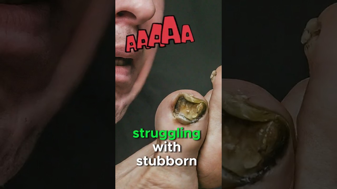 NanoDefense Pro – Hand and Foot Nail Fungus Relief