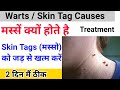 मस्सें (Skin tags) का permanent इलाज || मस्से क्यों होते है || Skin tags permanent cure