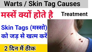 Download Lagu Permanent cure for skin tags || Why do warts occur || Skin tags permanent cure Download Lagu Permanent cure for skin tags || Why do warts occur || Skin tags permanent cure