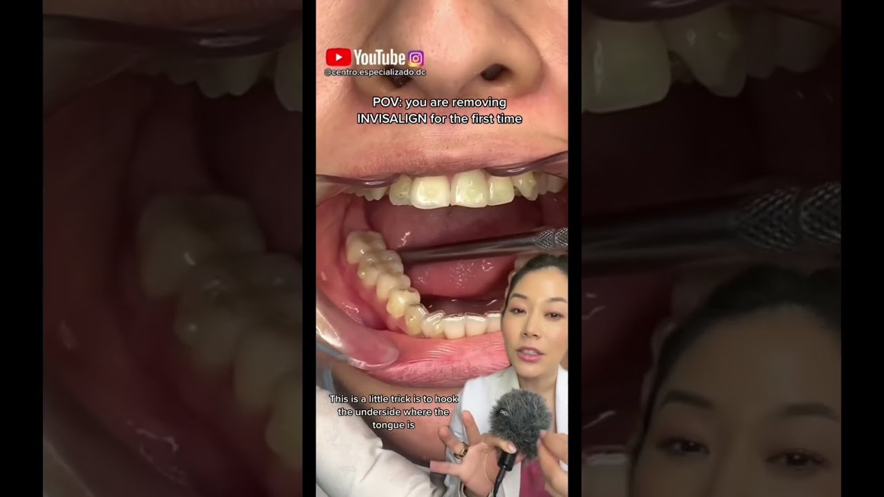 Trick To Remove Invisalign Retainers Dentist Braces