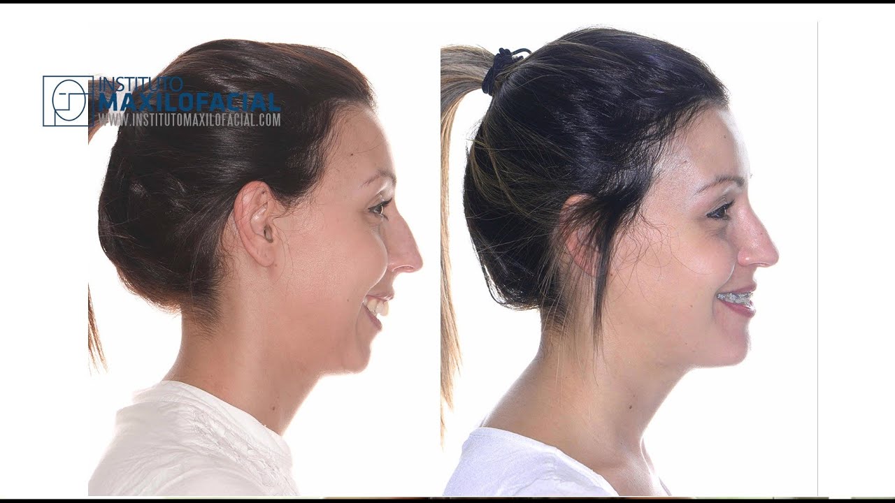 Cirugía ortognática bimaxilar. Caso # 72: Irina - Clase2, Biretrusión, hipoplasia mandibular