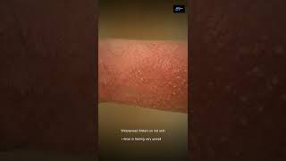 When psoriasis is an emergency