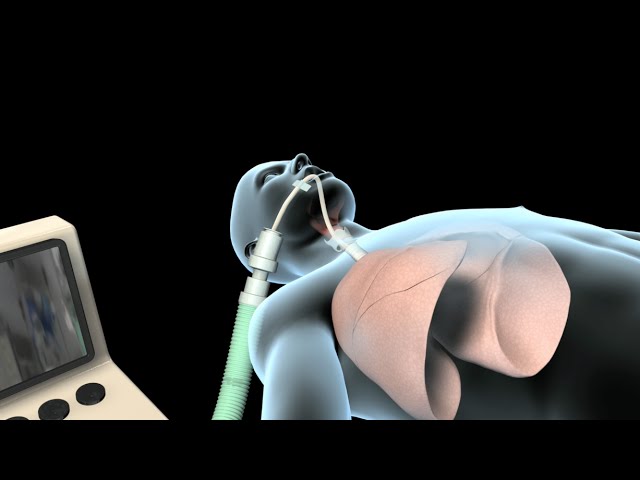 Intubation & Mechanical Ventilation (Ventilator) - YouTube