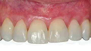 VISTA Technique - Homa Zadeh - Treatment of Gingival Recessions