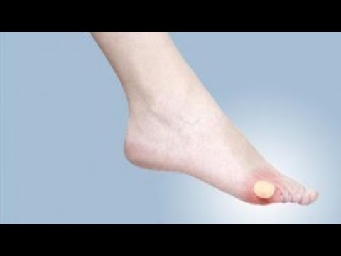 حل مشكل تقرحات الأقدام بسبب الحذاء