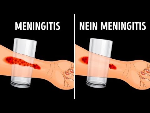 Video: Meningitis: Bilder Von Hautausschlag Und Anderen Symptomen