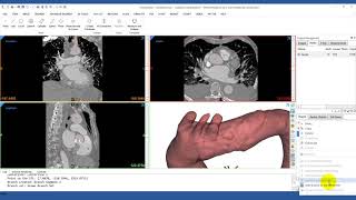 How to Analyze the Centerline of the Aorta | Mimics Innovation Suite | Materialise Medical screenshot 1