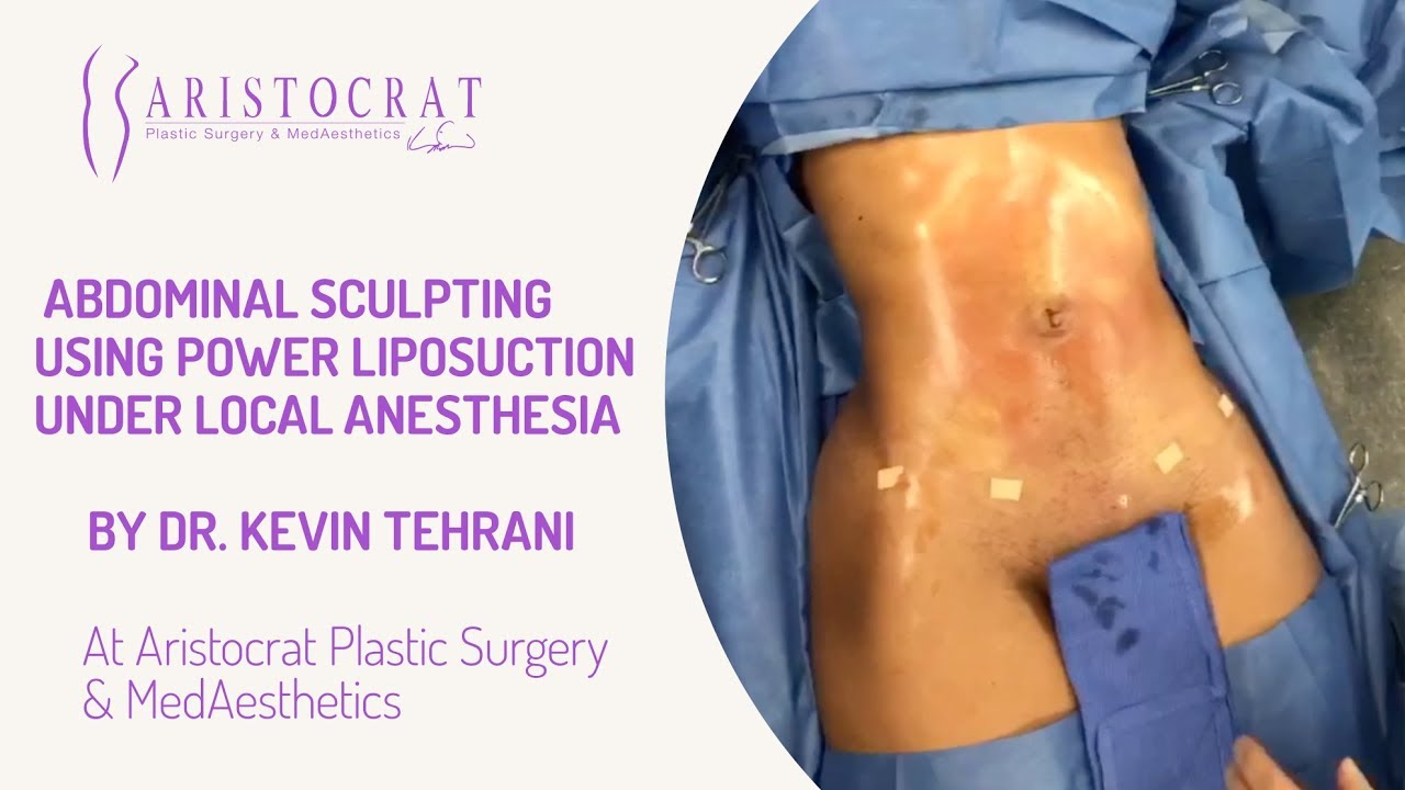 To-do List: How to Prepare for and Recover from Liposuction – Aristocrat  Plastic Surgery