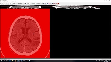 Methods in Neuropsychology Tübingen - Tutorial 1 Lesion Delineation and Normalisation