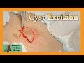 Cyst Excision: Edited | Auburn Medical Group