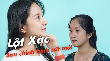 LỘT XÁC NGOẠN MỤC CỦA CÔ GIÁO MẦM NON SAU KHI CHỈNH HÌNH SỨT MÔI HỞ HÀM ẾCH