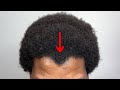 his hairline required EXTRA ATTENTION