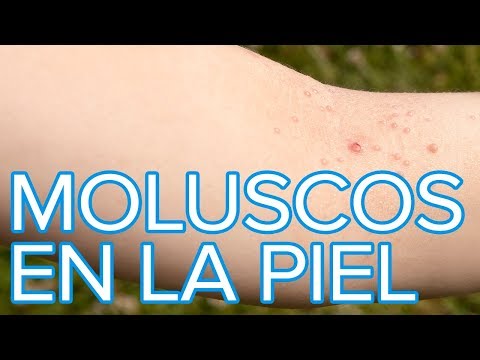 Video: Cómo prevenir infecciones de la piel: 14 pasos (con imágenes)