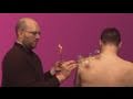 How To Do Cupping Therapy