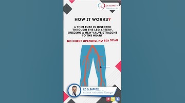 TAVR: Heart Valve Replacement Without Open Surgery! | Dr. K. Saketh