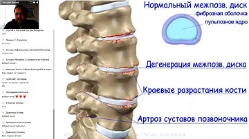 Врач-иммунолог, ДМН, Геннадий Кулеша о заболеваниях позвоночника и суставов