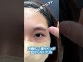 目の上切開＋眉下リフトのシミュレーション、二重ラインはどう変化する❓