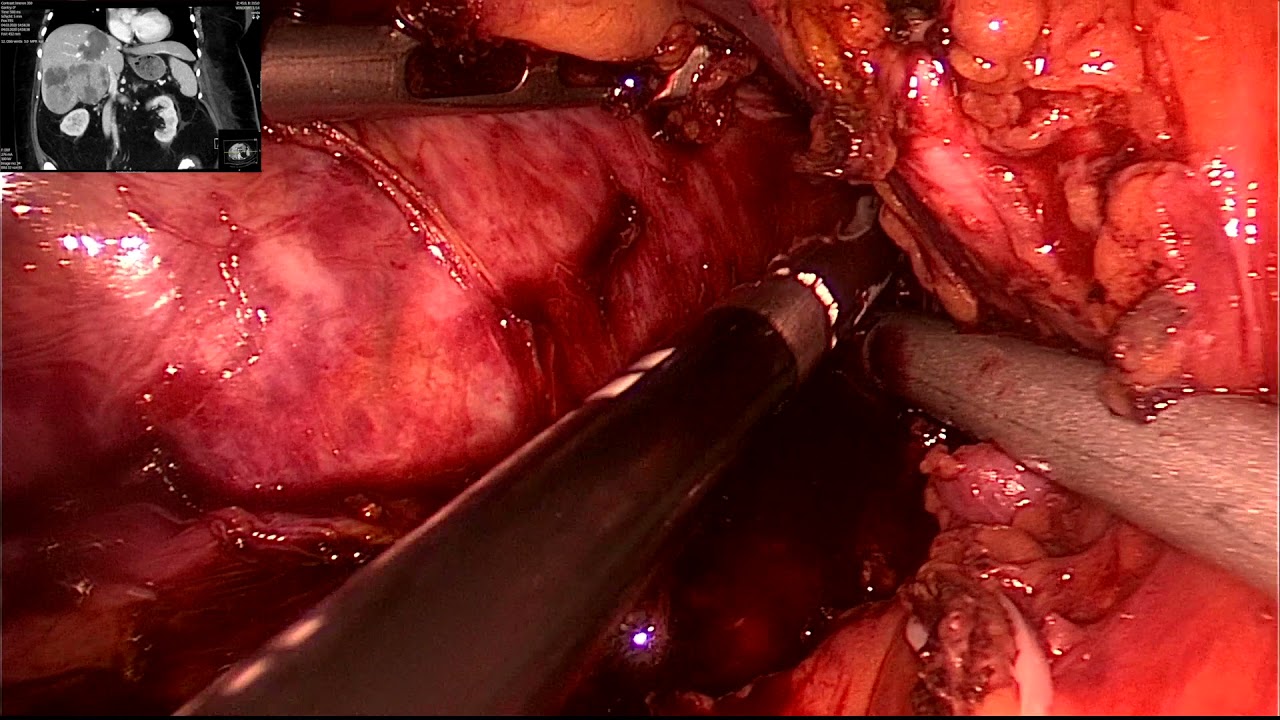 FULL LAPAROSCOPIC EXTENDED RIGHT HEPATECTOMY FOR LARGE HCC IN AN EXTREME CASE