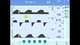 Ventilatory Management in ARDS and Protective Lung Strategy