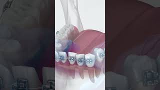 Types Of Braces Wires | NITI Wires