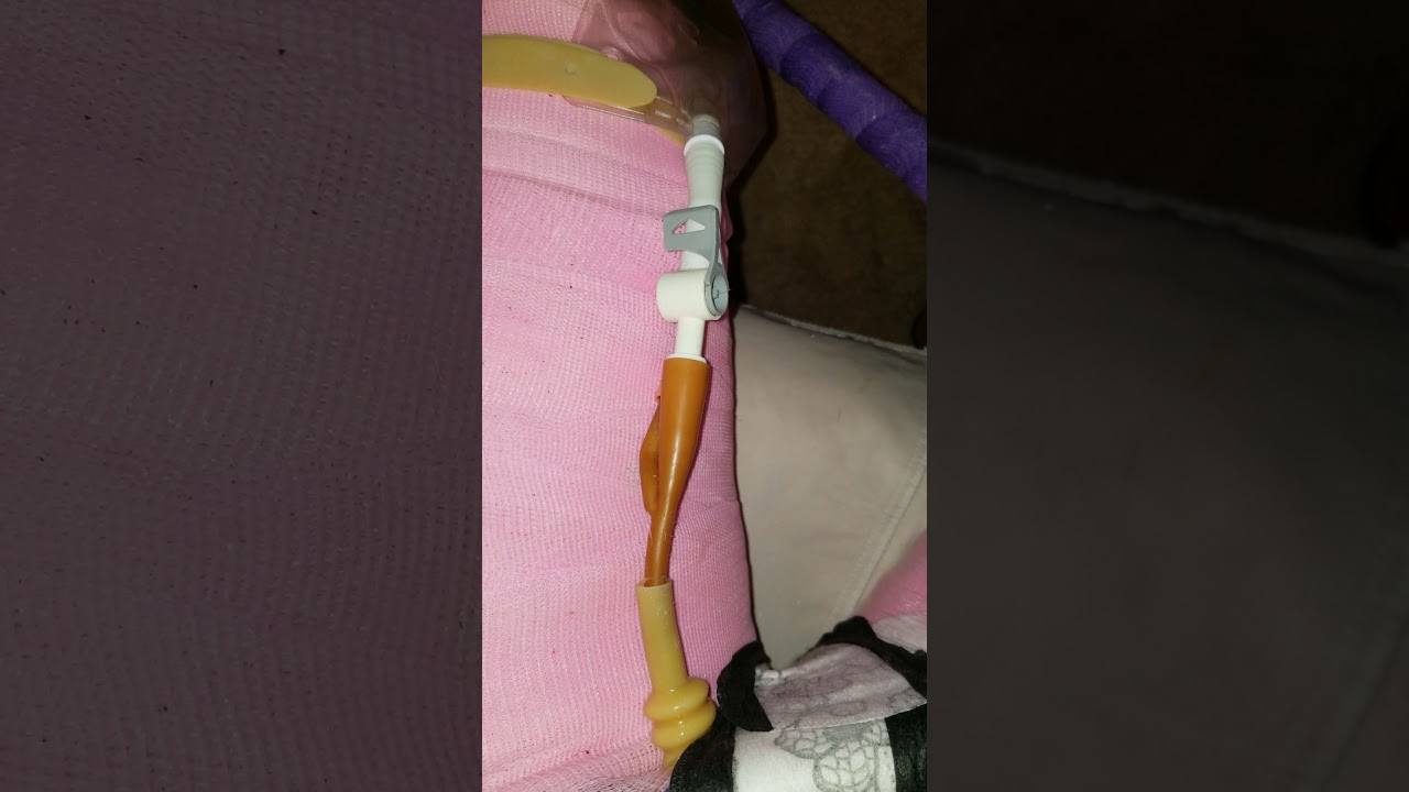 Body Cast Catheter