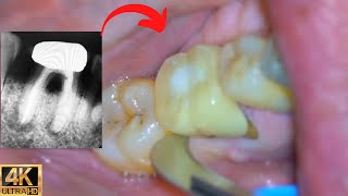 Surgical Tooth Extraction w/ Microscope (LIVE) by Smile Influencers 13,818 views 1 year ago 3 minutes, 14 seconds