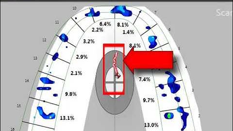 T-Scan: Center of Force