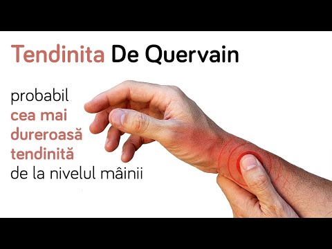 Tendinita De Quervain - tot ce trebuie să știi despre cea mai dureroasă tendinită a mâinii