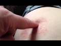 Apple Cider Vinegar Mole Removal Problems
